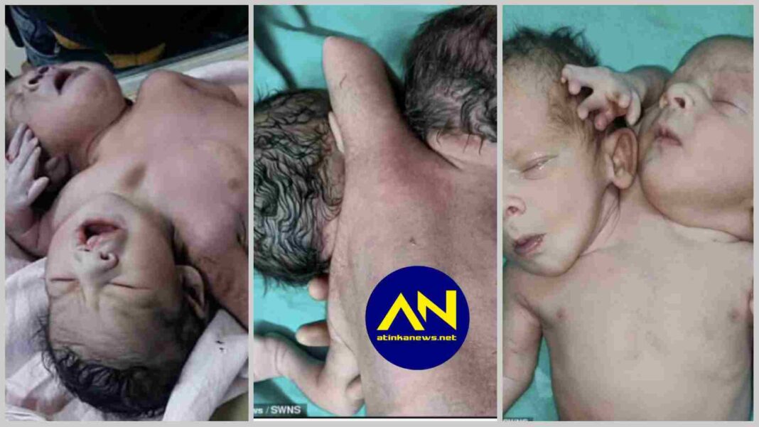 Baby born with two heads, three arms and two hearts